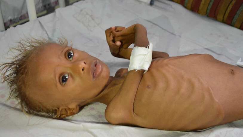 Unterernährtes Kind im Jemen: Das Kinderhilfswerk Unicef benötigt nach eigenen Angaben 3,9 Milliarden Dollar für Kinderhilfsprogramme in 59 Ländern. (Archivbild)