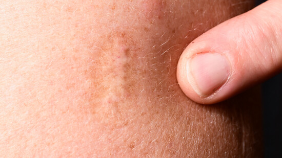 Eine Narbe einer Pockenimpfung an einem Oberarm. (Archivbild)