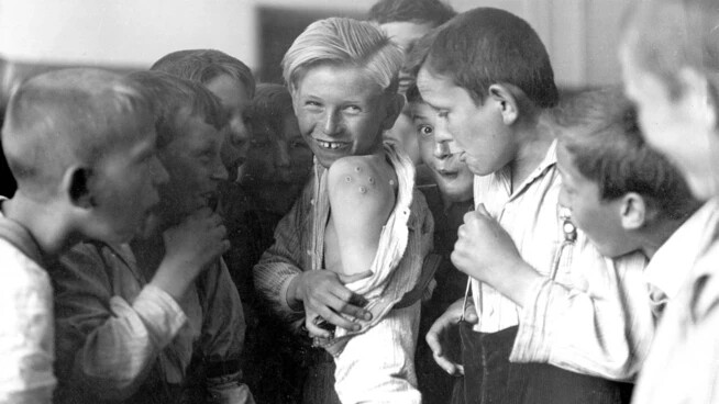 Zum Schutz vor den Pocken: Ein Junge zeigt um die 1930er-Jahre seine Impfnarben.