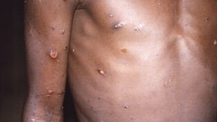 HANDOUT - Dieses vom CDC zur Verfügung gestellte Bild aus dem Jahr 1997 zeigt einen Patienten, dessen Haut eine Reihe von Läsionen aufwies, die auf einen aktiven Fall von Affenpocken zurückzuführen waren. Die WHO rechnet mit einem Anstieg der Zahl der…